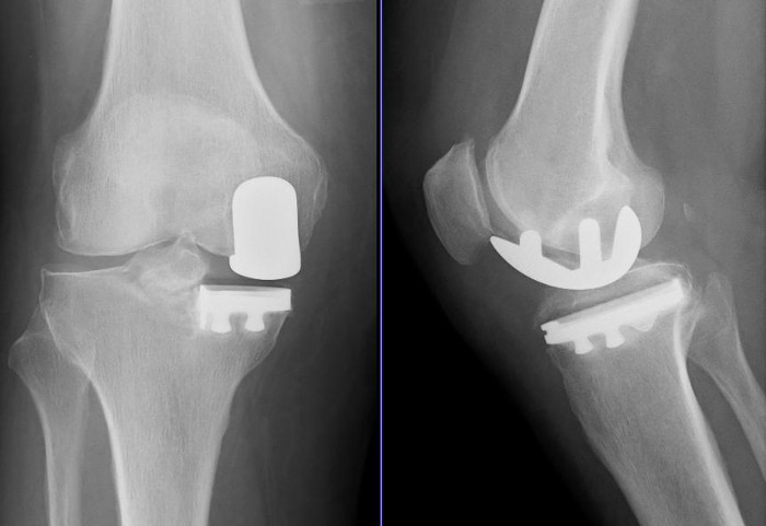 Endoproteza kolana jednoprzedziałowa - zdjęcie RTG