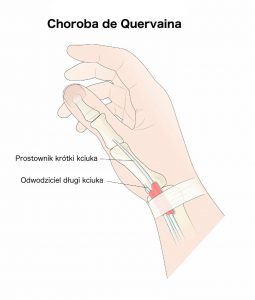 Choroba de Quervaina - prostownik krótki i odwodziciel długi