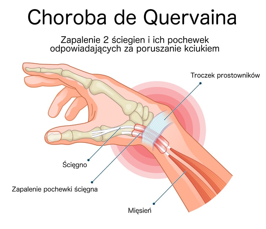 Zespół de Quervaina - zapalenie pochewek ściegien nadgarstka - ilustracja