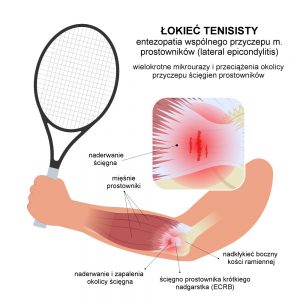 Anatomia łokcia tenisisty - entezopatii wspólnego przyczepu mięśni prostowników