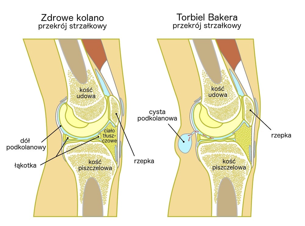 Przekrój strzałkowy torbieli Bakera i zdrowego kolana
