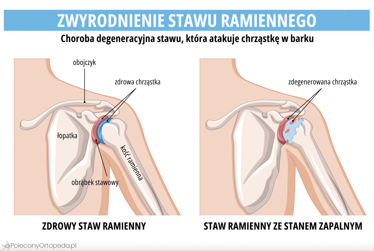 Omartroza i zdrowy staw ramienny porównanie