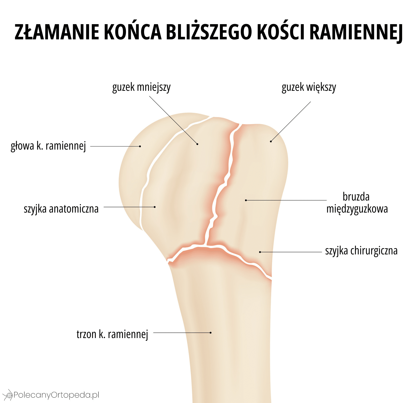 Złamanie kości ramiennej - obraz anatomiczny
