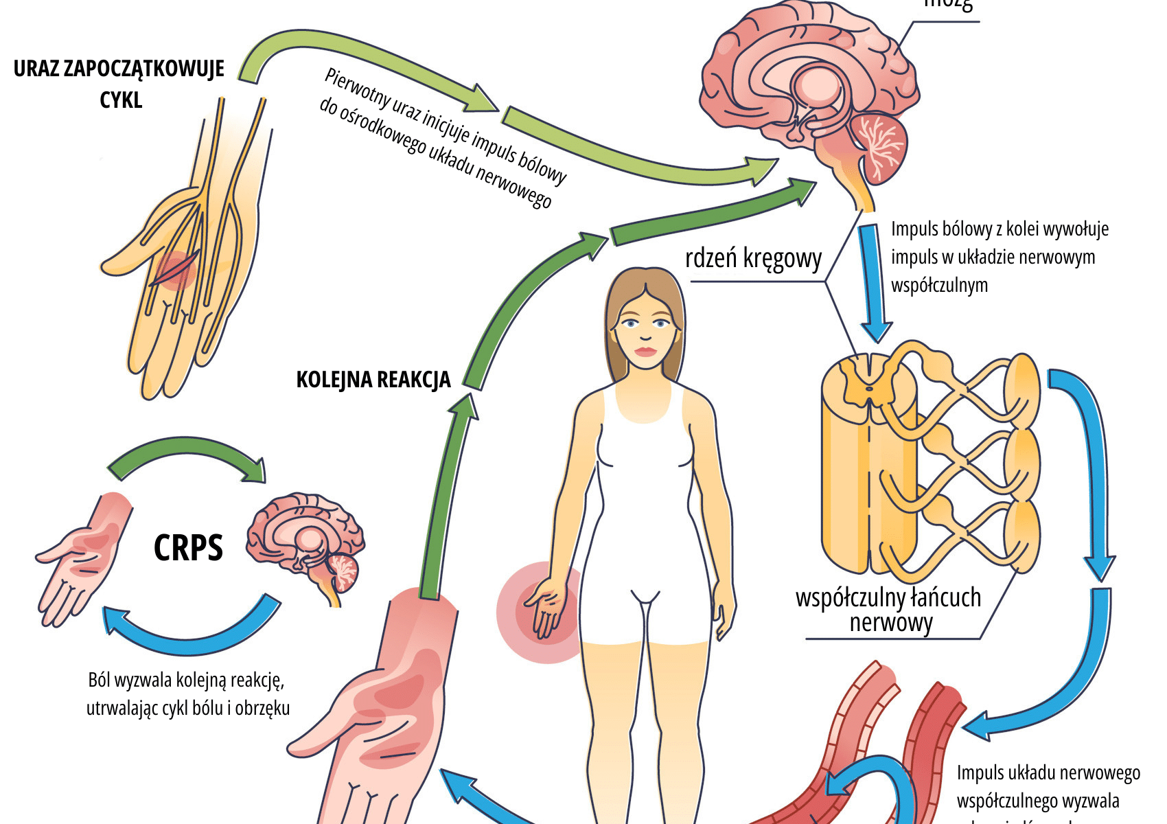 Infografika przedstawiająca zespół Sudecka i reakcję organizmu na uraz