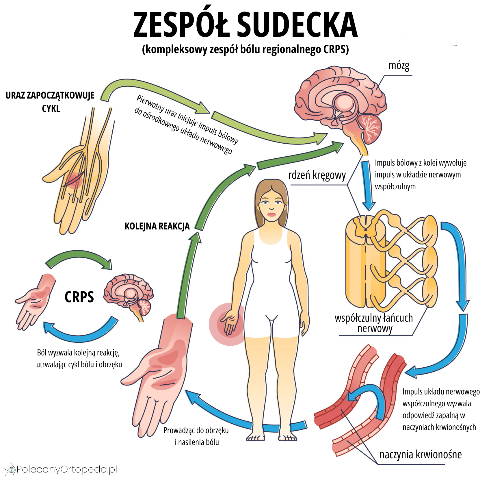 Infografika przedstawiająca zespół Sudecka i reakcję organizmu na uraz