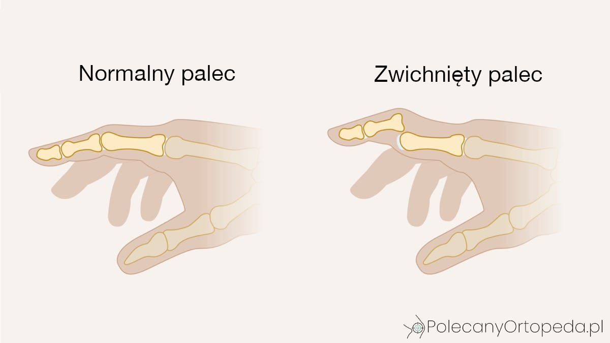 Ilustracja przedstawia budowę kostną dwóch palców w widoku bocznym - po lewej stronie prawidłowe ułożenie kości palca, po prawej stronie widoczne przemieszczenie kości w stawie wskazujące na zwichnięcie