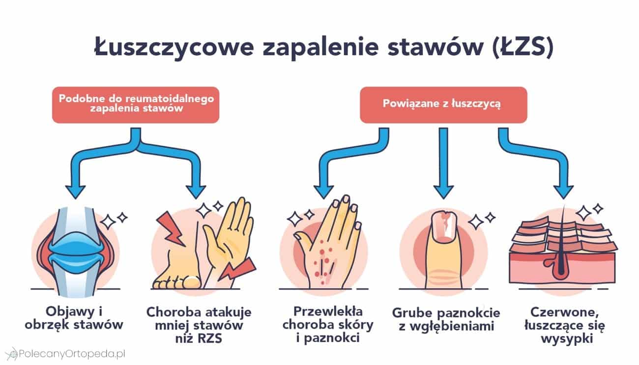 Infografika przedstawiające objawy łuszczycowego zapalenia stawów