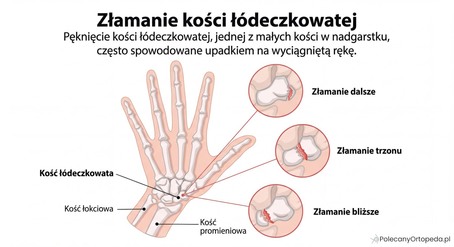 Schemat anatomiczny przedstawiający złamanie kości łódeczkowatej nadgarstka z zaznaczeniem trzech typów złamań