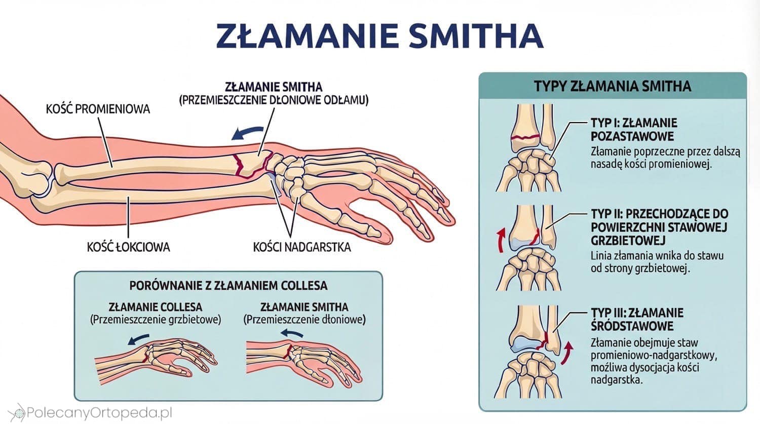 Schemat medyczny złamania Smitha przedstawiający anatomię przedramienia z zaznaczonym przemieszczeniem dłoniowym odłamu kości promieniowej