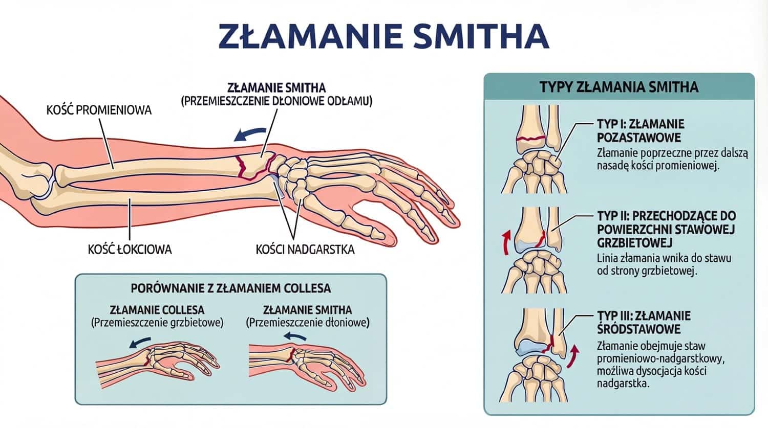 Schemat medyczny złamania Smitha przedstawiający anatomię przedramienia z zaznaczonym przemieszczeniem dłoniowym odłamu kości promieniowej