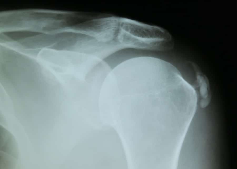Zdjęcie rentgenowskie zwapniałego barku (Tendinosis calcarea)